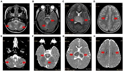 Acute necrotizing encephalopathy in children with COVID-19: a retrospective study of 12 cases